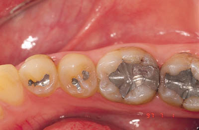 amalgama dentale otturazioni dentista colle val d elsa poggibonsi studio dentistico