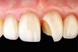 frattura dente trauma poggibonsi colle di val d elsa studio dentistico odontoiatra