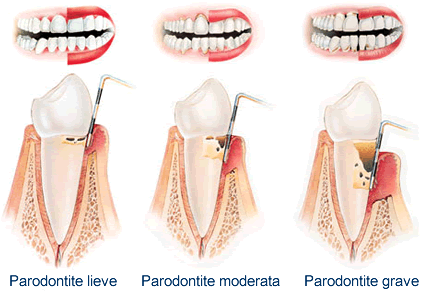 Piorrea parodontologia perdita attacco denti
