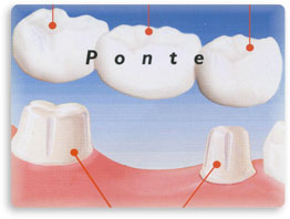 ponte dentale impianti denti naturali
